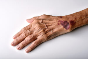 What is My Lexington Nursing Home Abuse Case Worth?